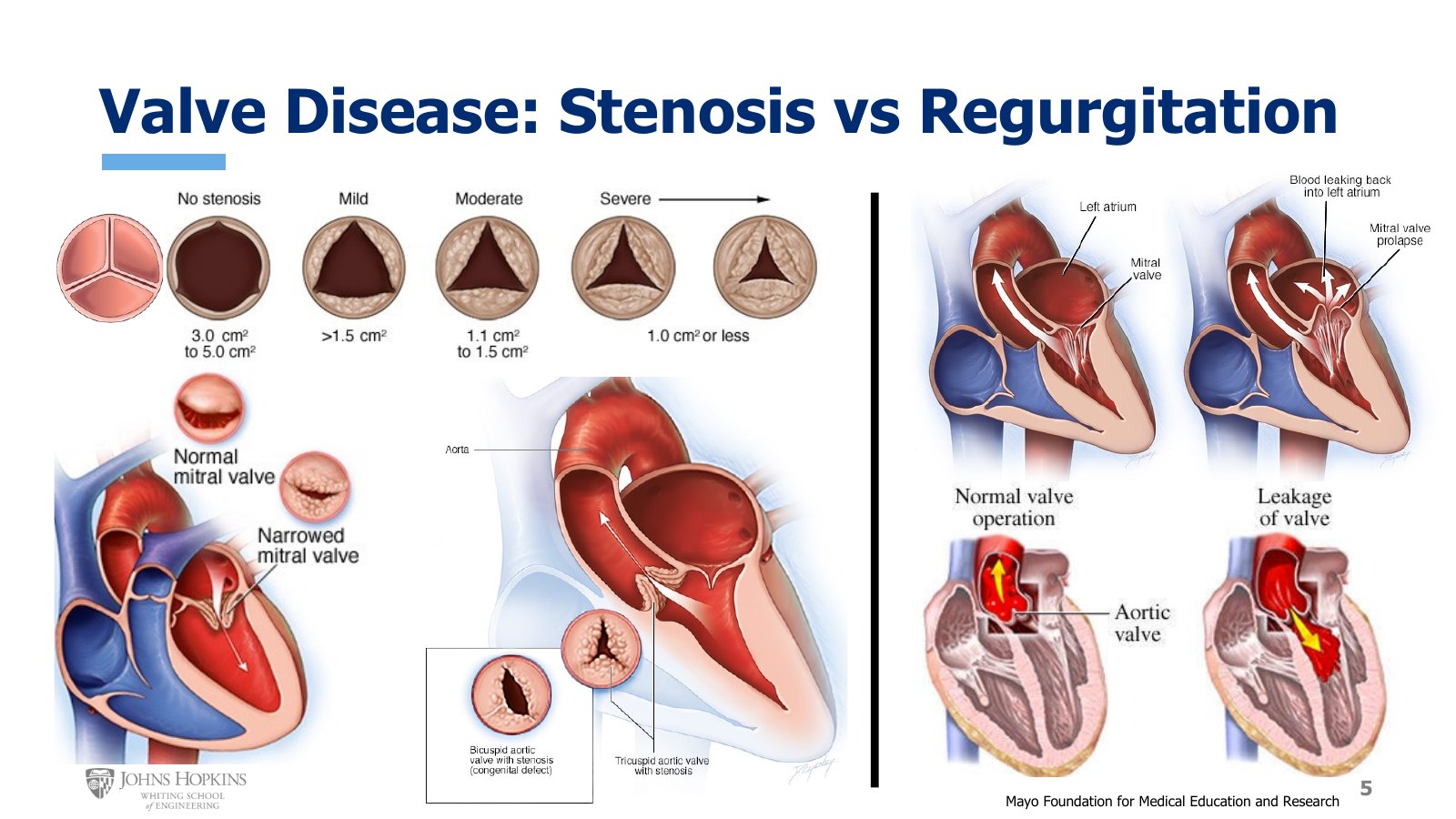 Slide 5: Left, aortic stenosis graded from none to severe, a narrowed mitral valve, and a bicuspid aortic valve. Right, mitral and aortic regurgitation against normal forward flow.